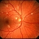 HIV Retinopathy